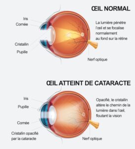 Comparaison oeil normal / oeil atteint de cataracte